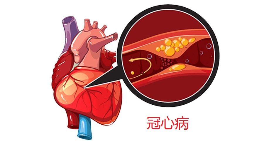 什么是冠心病？冠心病的二三事