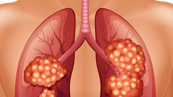 住院检查出间质性肺炎纤维化怎么办？间质性肺炎纤维化严重吗