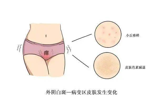 什么是外阴白斑？外阴白斑涂什么药膏最好