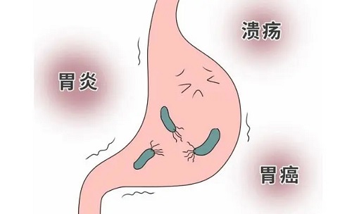 吃什么预防胃癌 如何饮食养生能远离胃癌