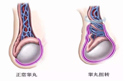 睾丸扭转会不会影响生育功能 睾丸扭转最佳治疗时间是什么